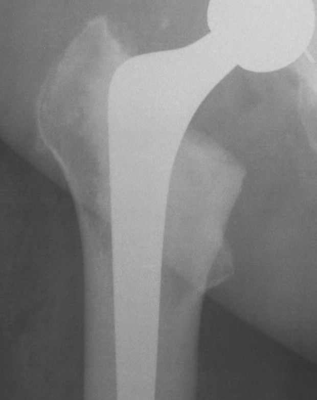 THR Type 1 Cemented Femur